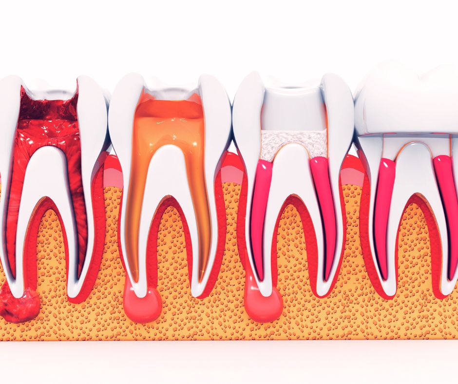 Root canal treatment Bulleen Dental