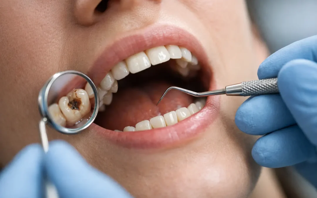 Early Signs of Tooth Decay You Shouldn’t Ignore
